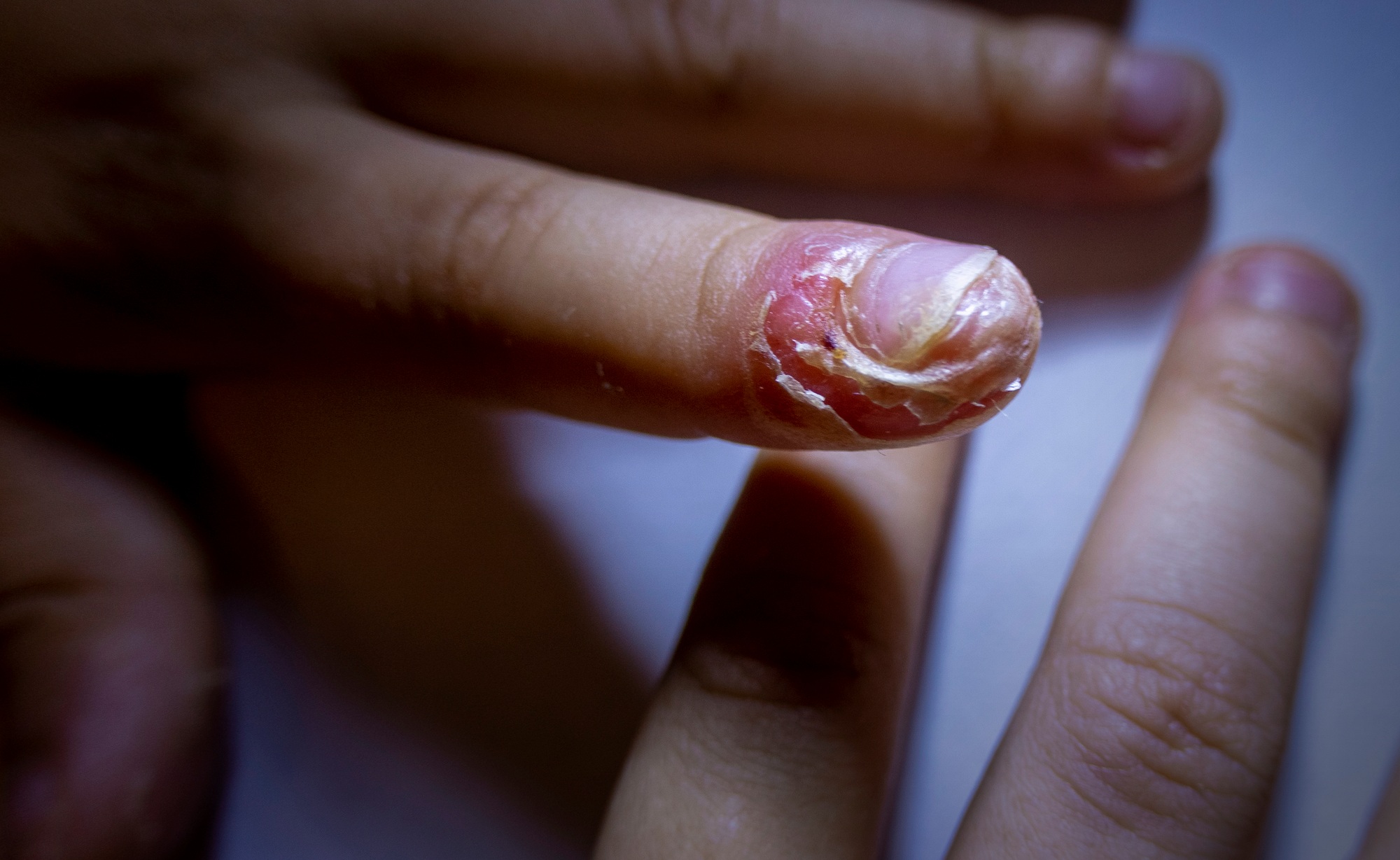 finger swollen with inflammation due to Nail ripped infection
