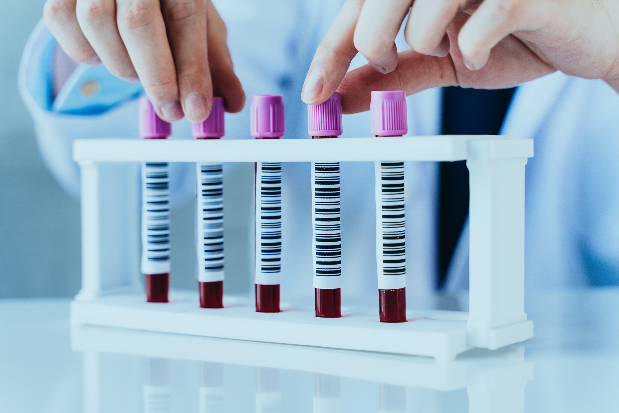 Hands of a lab technician with blood test sample tubes in a row for laboratory blood analysis