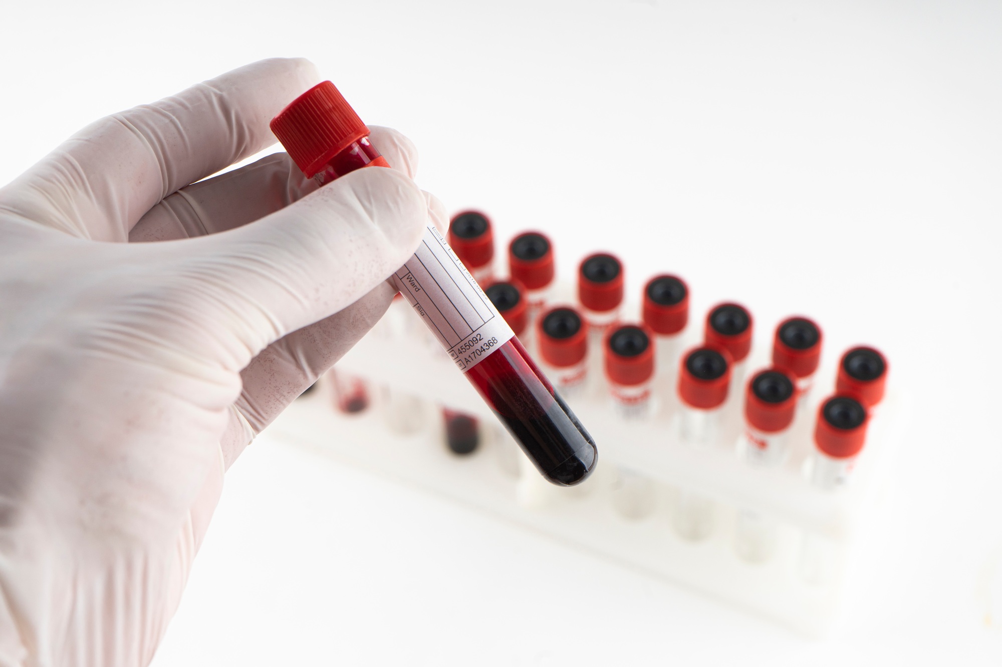 Test tube containing a blood sample test tube for Covid-19 (coronavirus) analyzing
